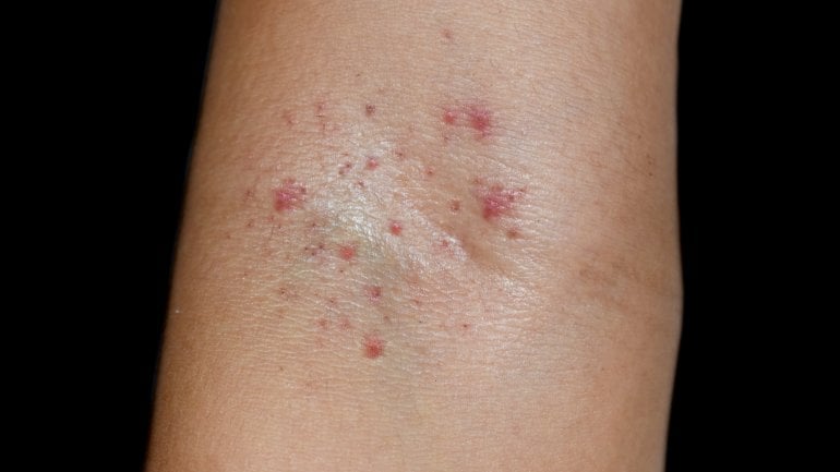 Meningitis: Hautausschlag kann Symptom sein