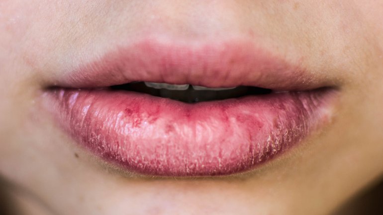 Eingerissene Mundwinkel durch trockene Lippen