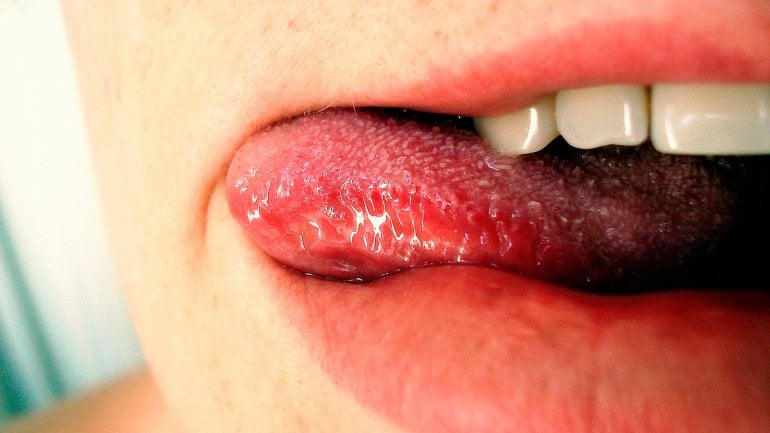 Ursache: Lippen lecken und mangelnde Feuchtigkeit