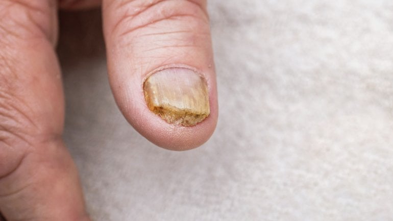 Nägel werden dick: Hinweis auf Nagelpilz