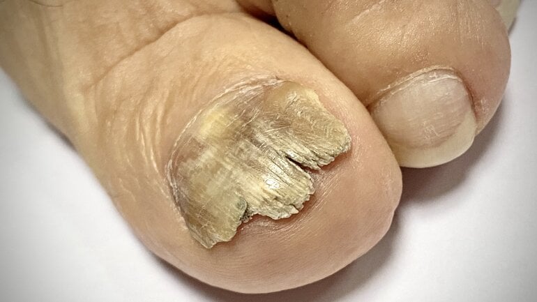 Nagelpilz erkennen: Bilder der Infektionskrankheit
