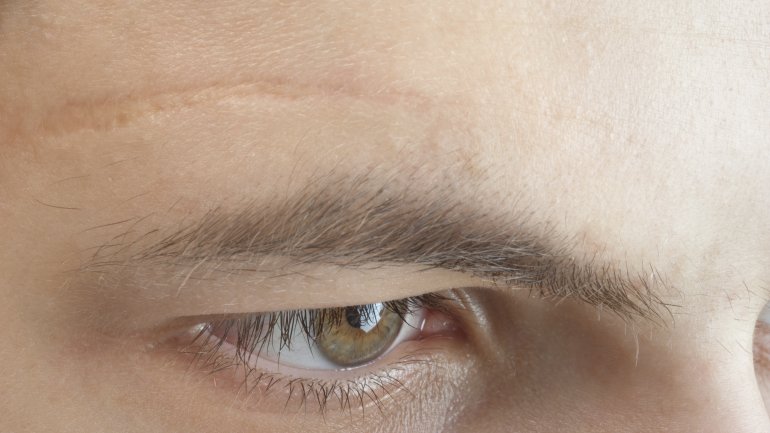Das Bild zeigt eine Narbe über dem Auge eines Mannes.