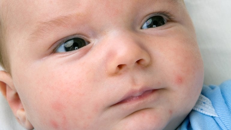 Das Bild zeigt einen Säugling mit Neugeborenenakne, roten Pickelchen.