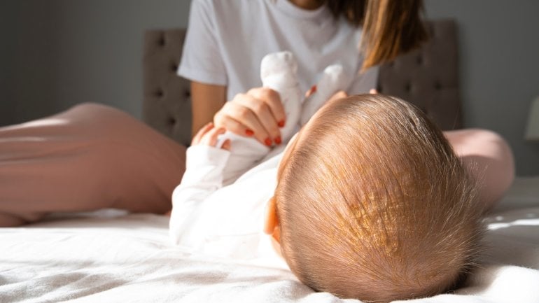 Neurodermitis-Bilder: Milchschorf beim Baby