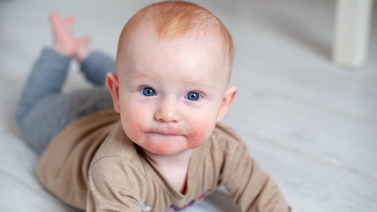 Neurodermitis bei Babys: Bilder des Hautausschlags