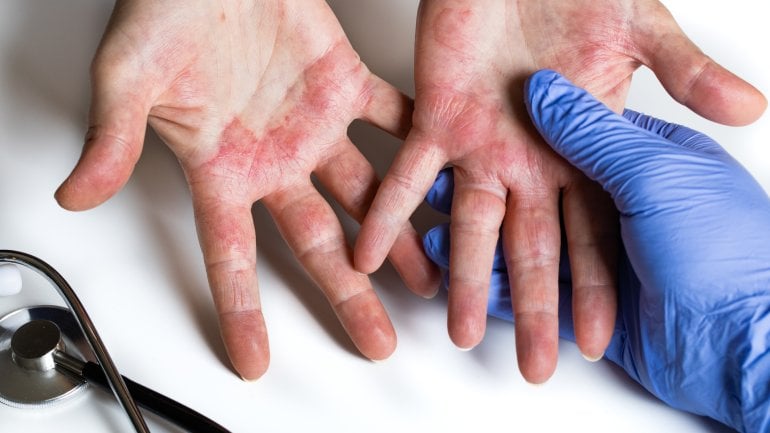 Neurodermitis der Hand: Ekzem ist ein typisches Symptom