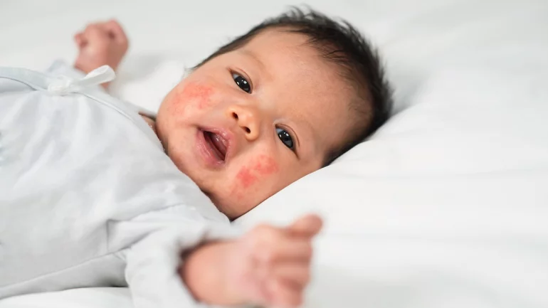 Neurodermitis beim Baby tritt meist im Gesicht auf