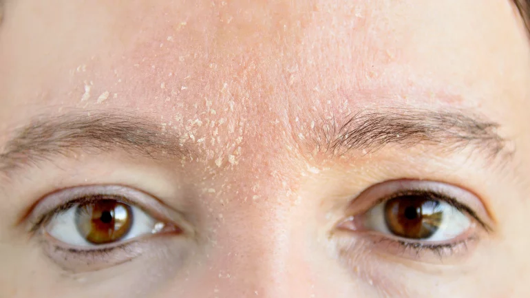 Neurodermitis an den Augen: Schuppige Stellen möglich