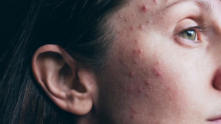 Akne: Schlechtes Hautbild kann PCOS-Symptom sein