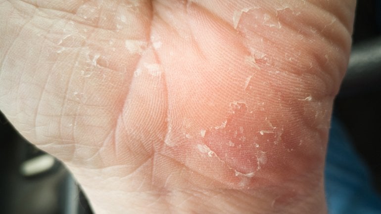Eine Hand mit einer Pilzinfektion