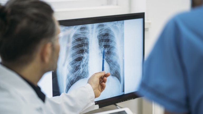 Pneumothorax: Ärzte analysieren Röntgenbild einer Lunge.