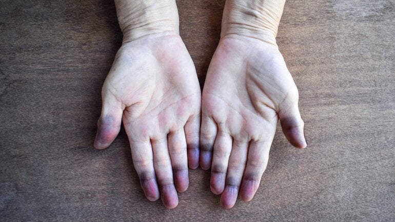 Bläuliche Lippen oder Fingernägel: Warnzeichen bei Lungenkollaps