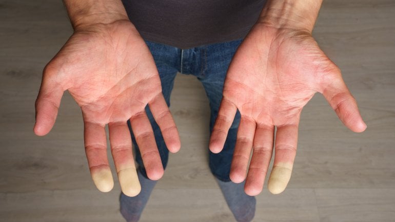 Bild von einem Mann mit Raynaud-Syndrom an den Fingern.