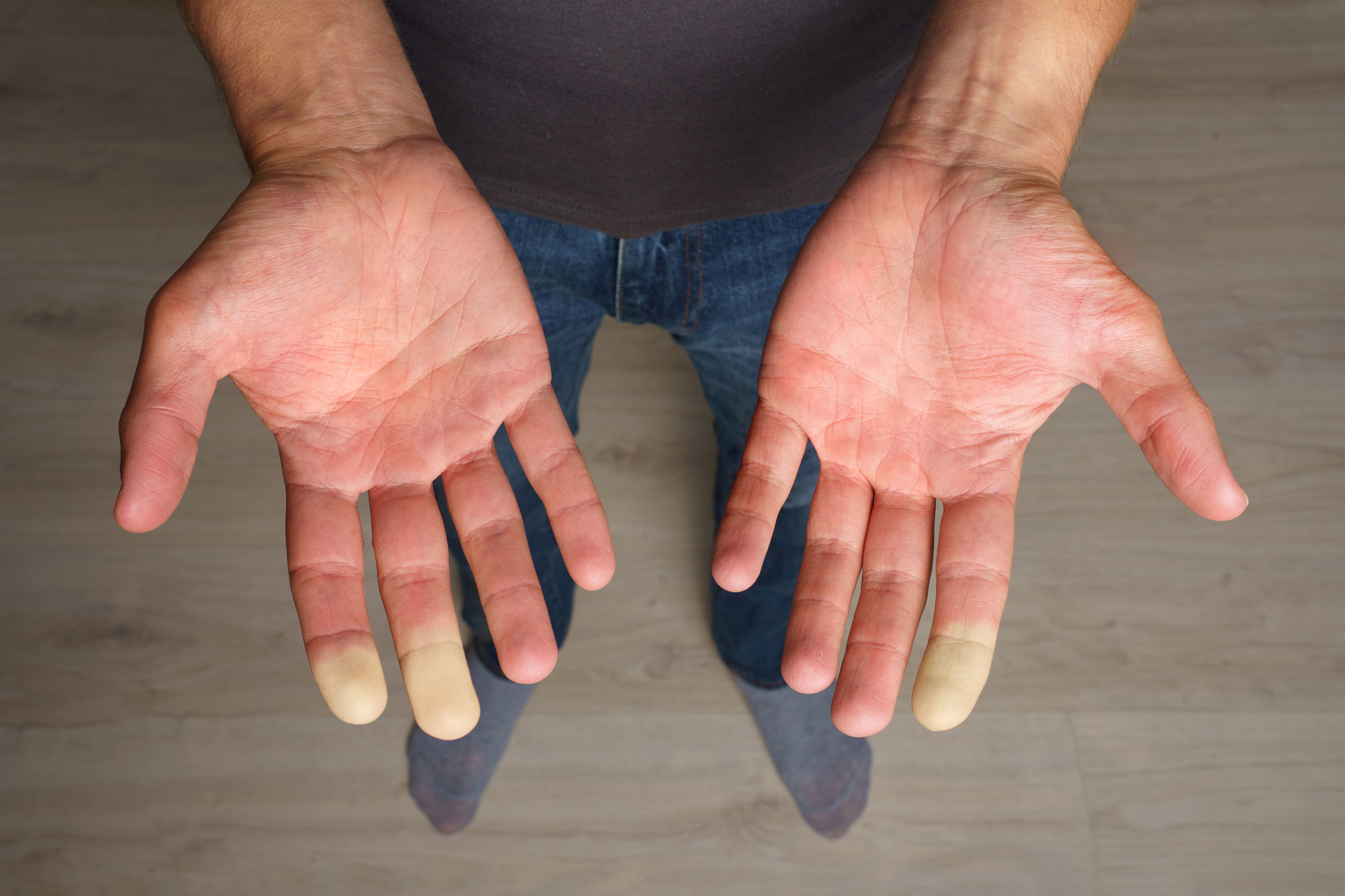 Raynaud-Syndrom: Weiße Finger und Füße
