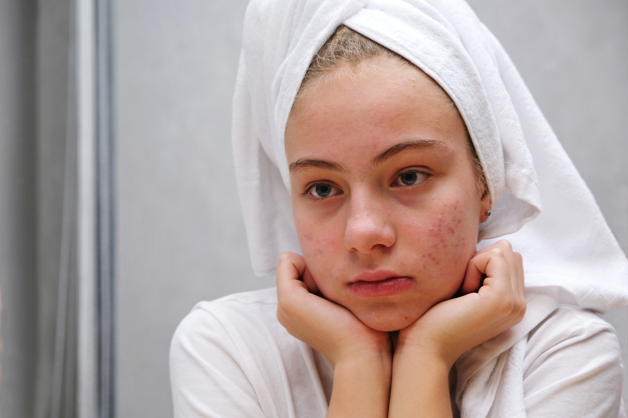 Skin Picking Disorder: Ursachen und Therapie der Zwangsstrung Skin Picking Disorder: Ursachen und Therapie der Zwangsstrung