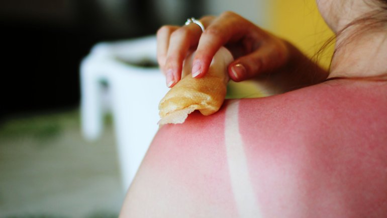 Das Bild zeigt eine Frau mit einem Sonnenbrand auf dem Rücken, die versucht, ihren Sonnenbrand zu behandeln. 