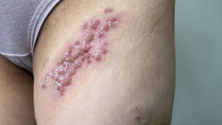 Hautveränderungen sind Symptome bei Spätsyphilis