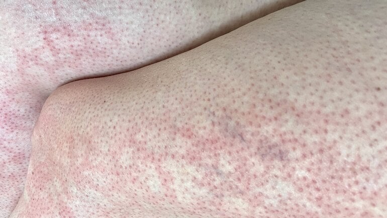 Toasted-Skin-Syndrom: Netzartige Rötung der Haut ist Symptom