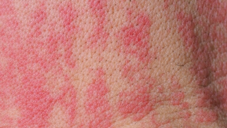 Dauerhaft marmoriertes Hautbild ist Symptom bei Toasted-Skin-Syndrom