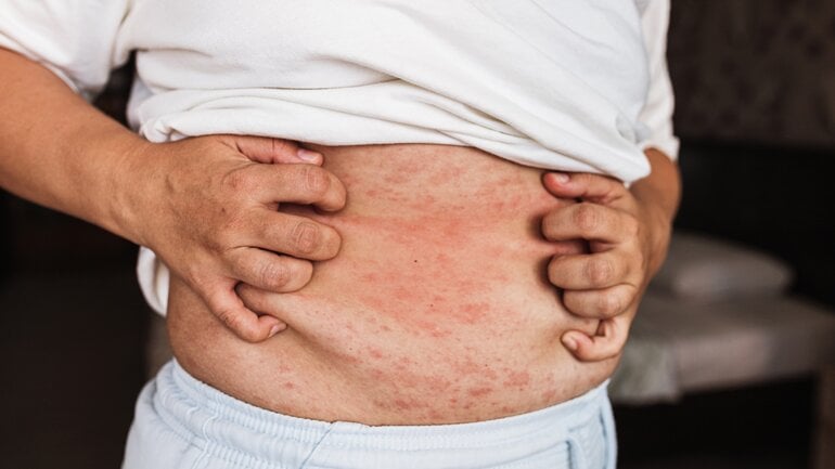 Brennen oder Schmerzgefühl: Symptome beim Toasted-Skin-Syndrom