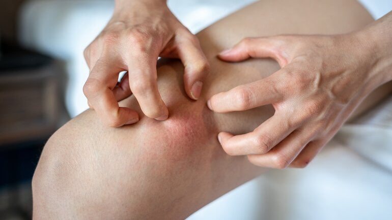 Symptom für Toasted-Skin-Syndrom: Juckreiz