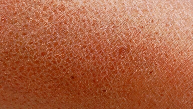 Trockene oder schuppige Haut: Symptom bei Toasted-Skin-Syndrom