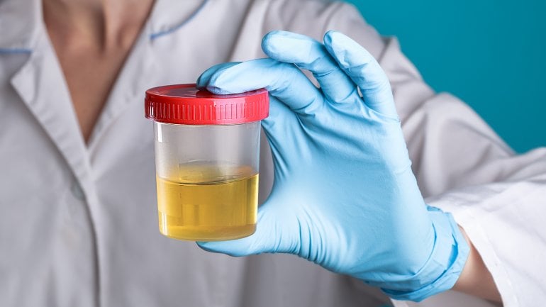 Eine Ärztin im weißen Kittel hält einen Becher mit einer Urinprobe vor sich in der Hand