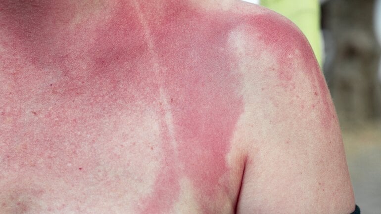 Verbrennung 1. Grades: Leichte Rötung der Haut