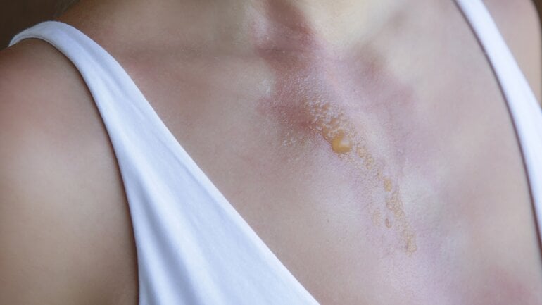 Verbrennung 2a: Oberflächliche Schädigung mit Blasenbildung 