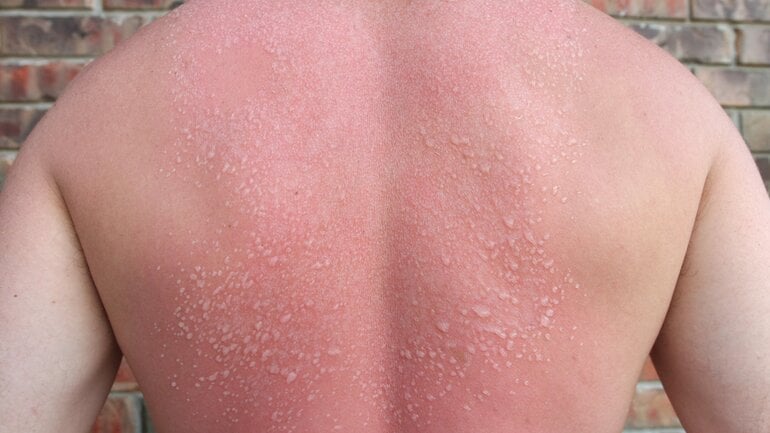 Bild einer Verbrennung 2. Grades mit Blasenbildung