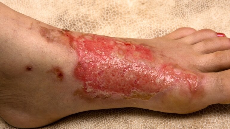 Verbrennung 2b: Tiefergehende Schädigung der Lederhaut