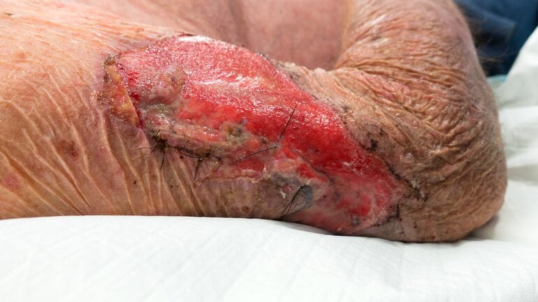 Verbrennung 3. Grades: Bild der Schädigung aller Hautschichten