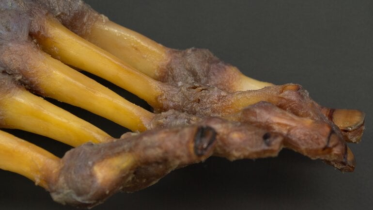 Verbrennung 4. Grades: Tiefe Gewebeschädigung bis zum Knochen