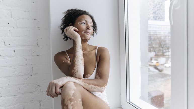 Eine junge Frau mit Vitiligo sitzt im Fensterrahmen und schaut betrübt aus dem Fenster