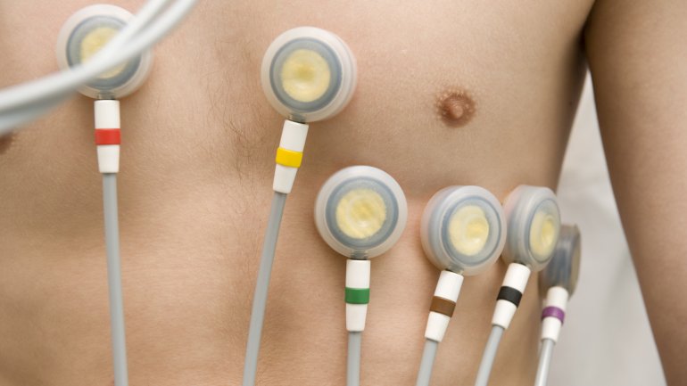 Man sieht sechs auf der Brustwand eines Mannes aufgebrachte EKG-Elektroden.