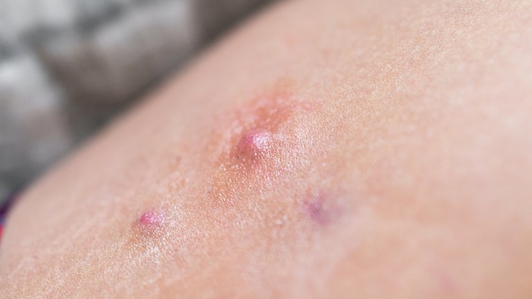 Hautkrankheiten erkennen: Akne inversa