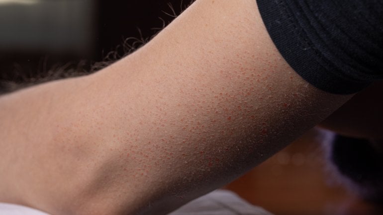 Bild von Keratosis pilaris: Hautkrankheiten erkennen